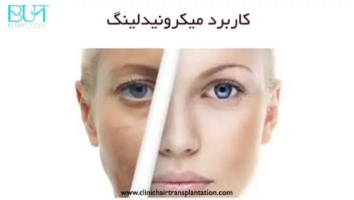 کاربردها و مزایای میکرونیدلینگ چیست